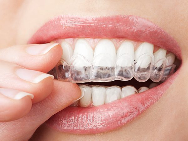 Keeping Your Teeth white: The best Choices for Your Now