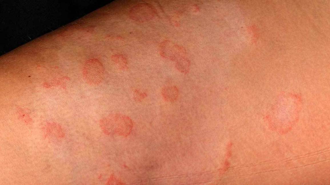 Is Ringworm skin infection caused by a parasite?