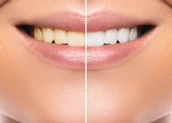 Teeth Whitening for Kids and Teens