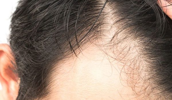 How do you use minoxidil on your scalp?