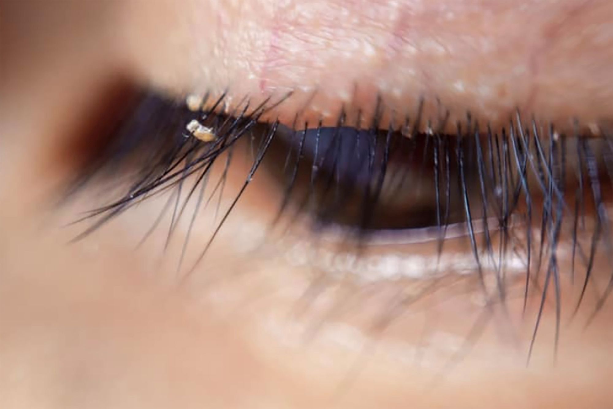 Itching and redness in eyes can be the symptoms of eyelash lice: