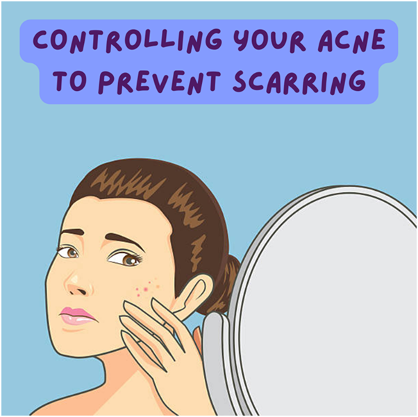    Acne Scars 101 – Learning To Control Your Acne To Prevent Acne Scars