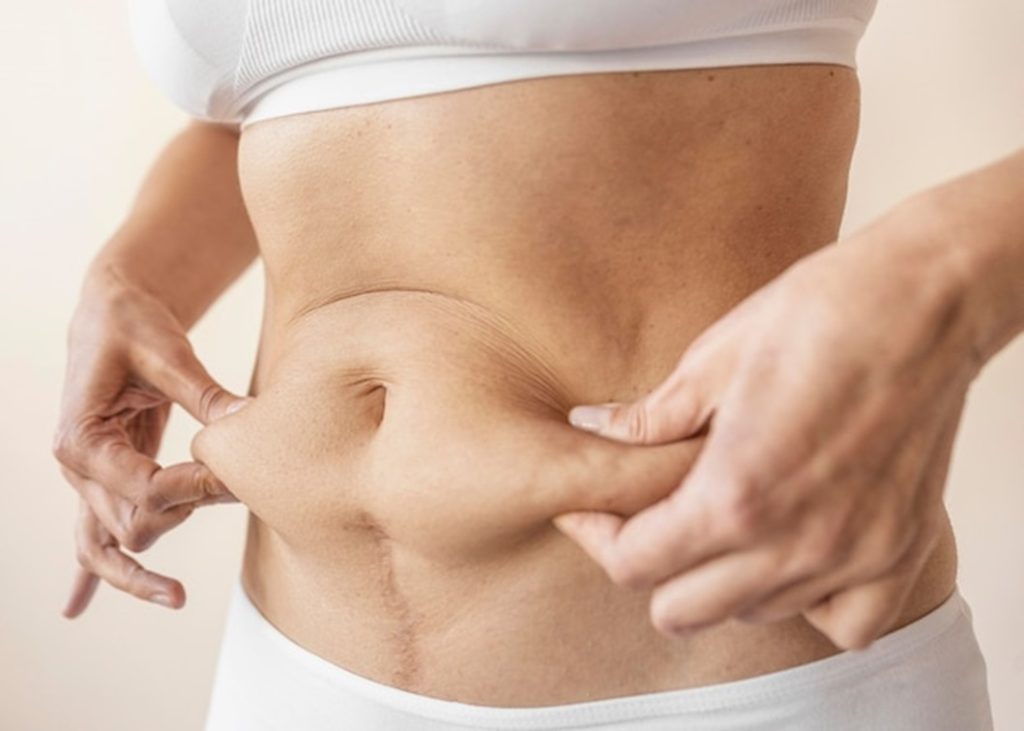 Tummy Tuck