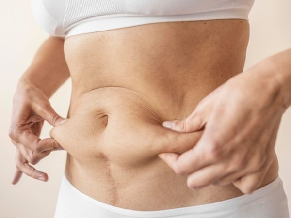 The Definitive Guide to Tummy Tuck