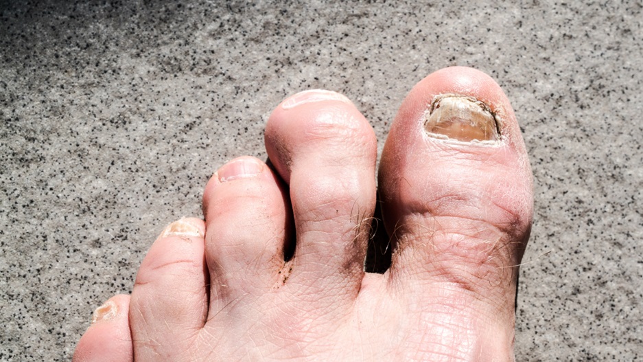 Understanding Hammertoe: Causes and Treatment Options