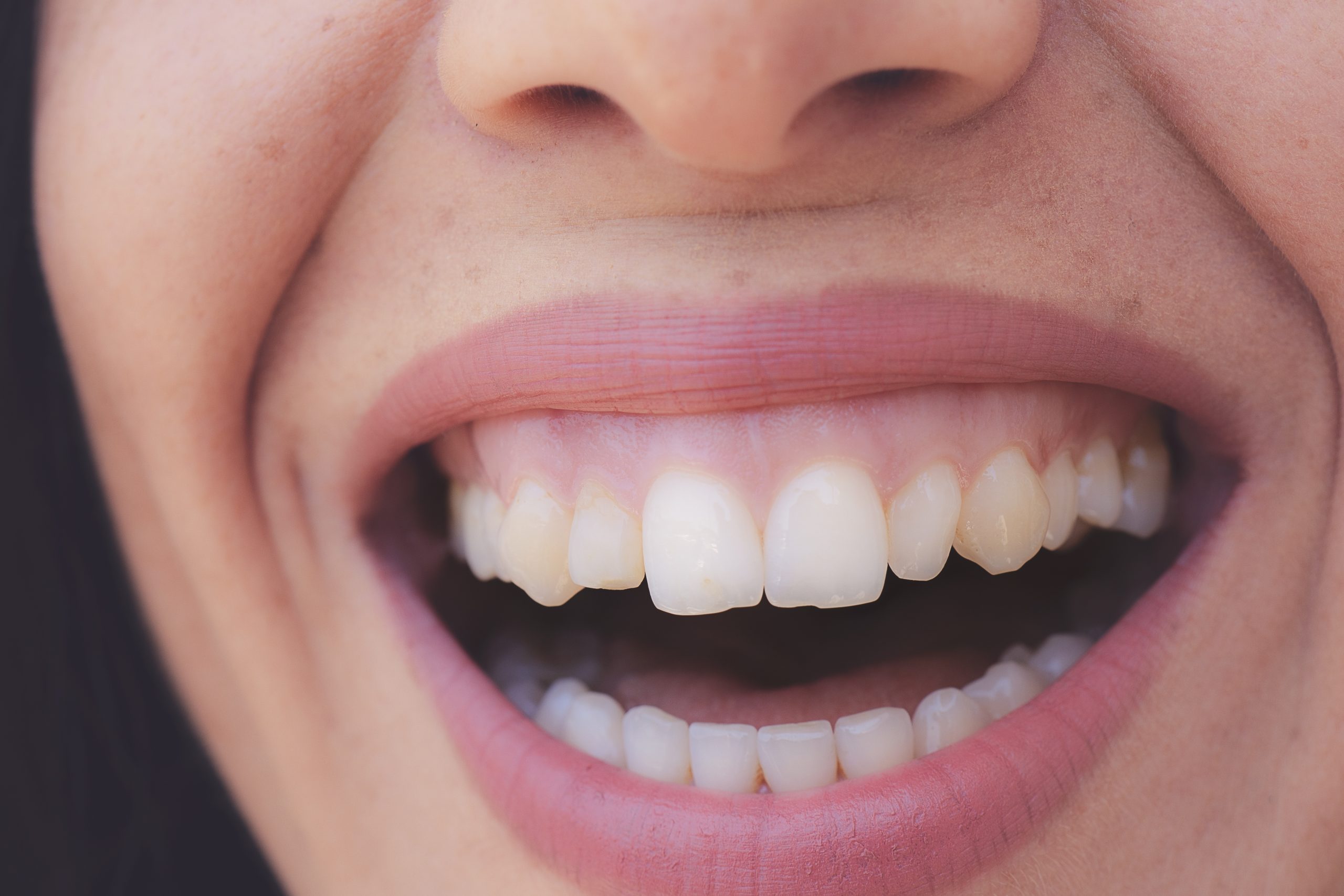5 Benefits of Gum Reshaping for Periodontal Health in Leesburg, VA
