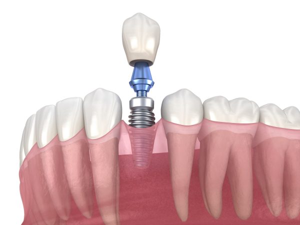 Are Dental Implants An Investment For Me? 