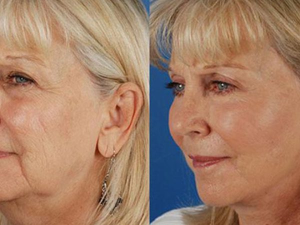 Lifted Midface That Still Looks Like You with Smile Line Reduction