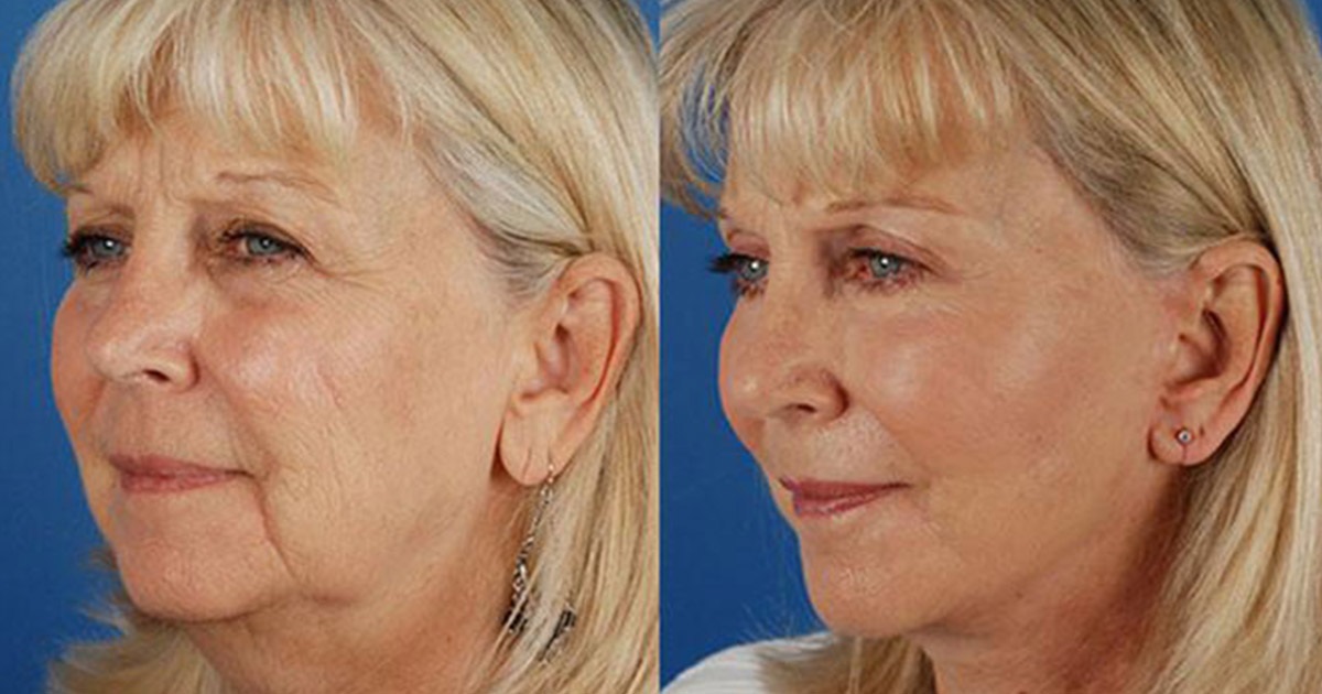 Lifted Midface That Still Looks Like You with Smile Line Reduction