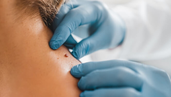 Expert Dermatologist for Skin Cancer Care